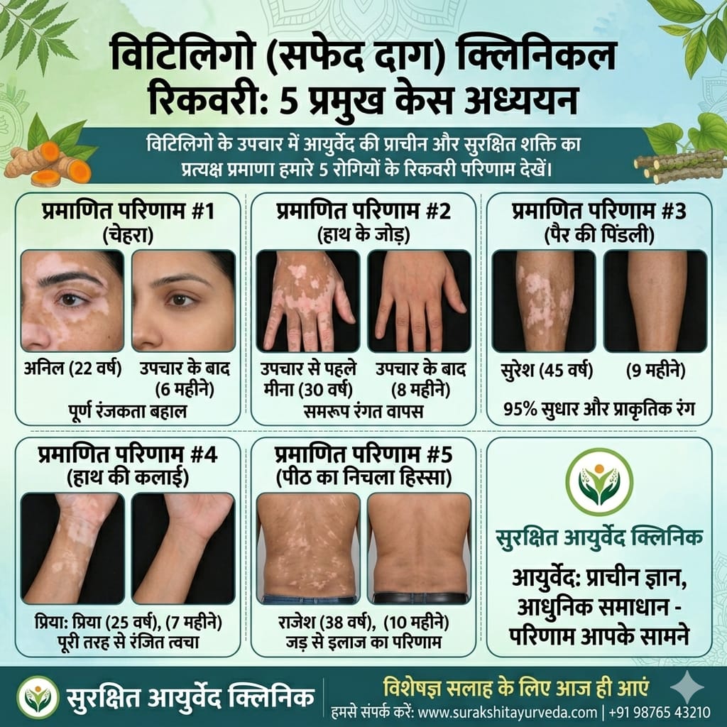 Before After Vitiligo Treatment Result